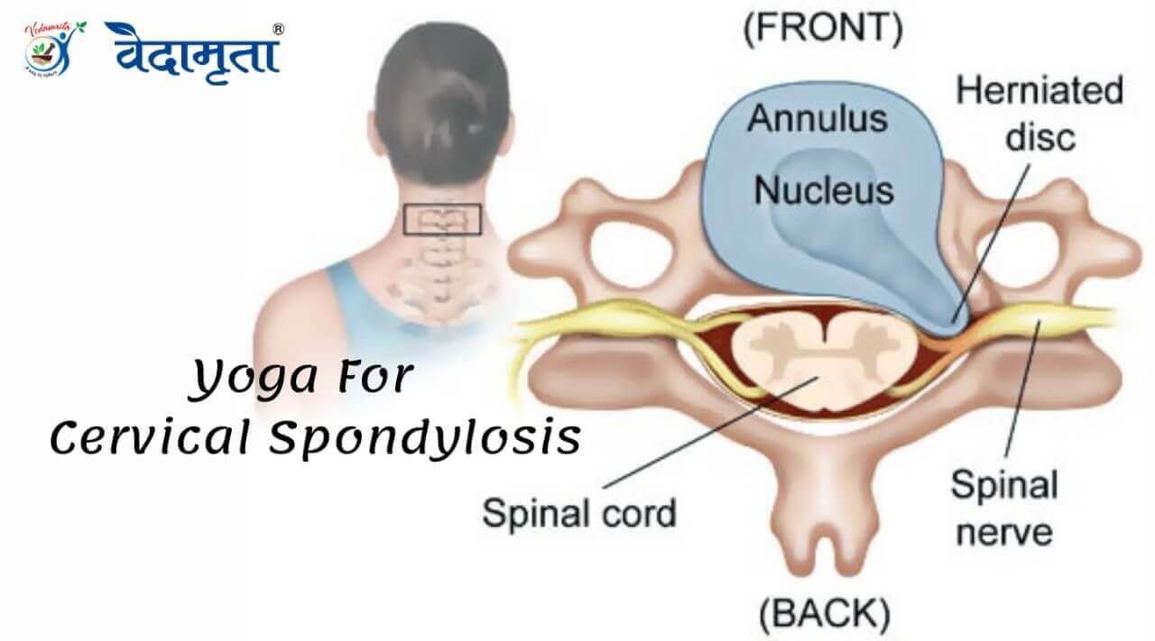 konasana yoga to improve cervical spondylitis